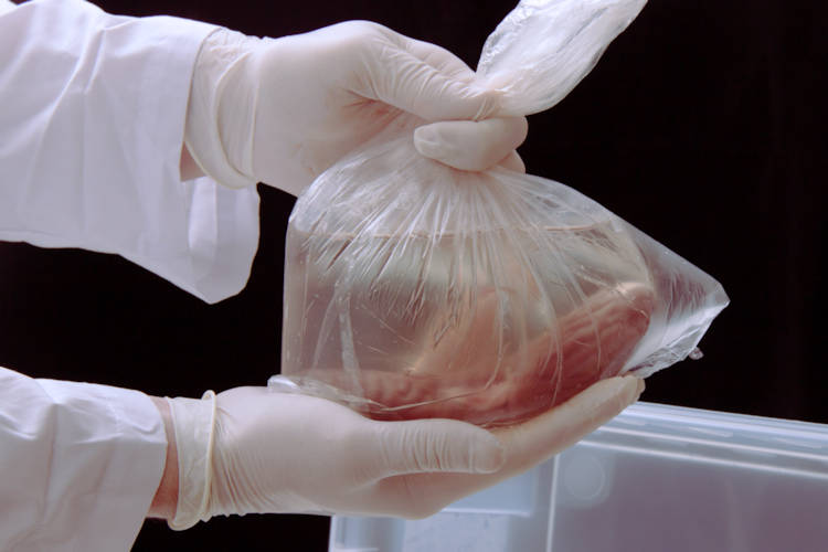 Meeste donoren willen orgaan pas afstaan na hun dood